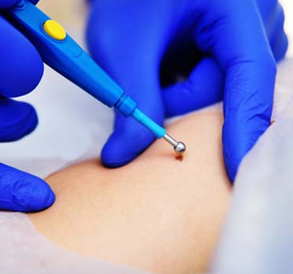 Elektrokoterizasyon ile Siğil Tedavisi