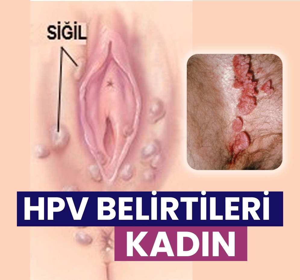 HPV Belirtileri Kadın