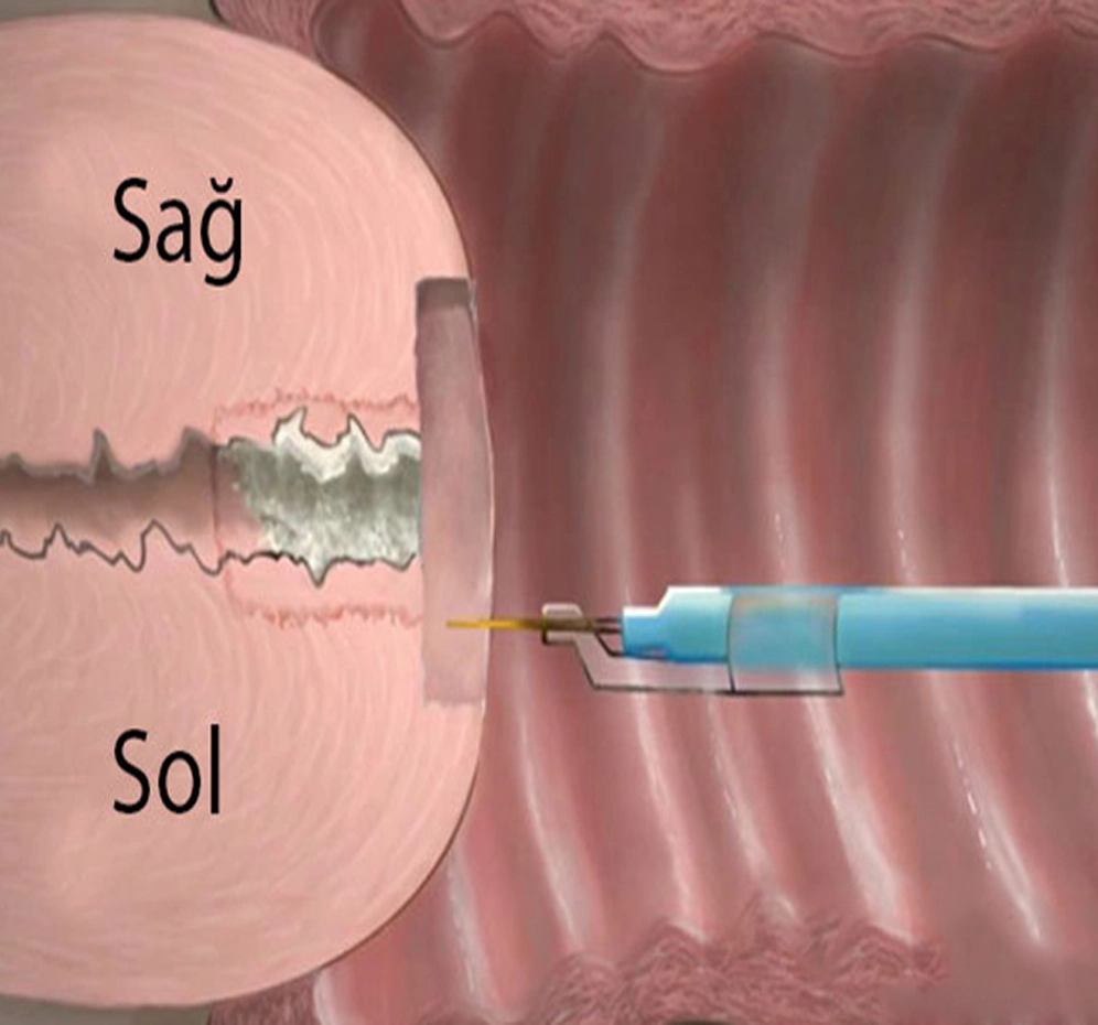 Konizasyon Nedir? | Rahim Ağzı Cerrahisi