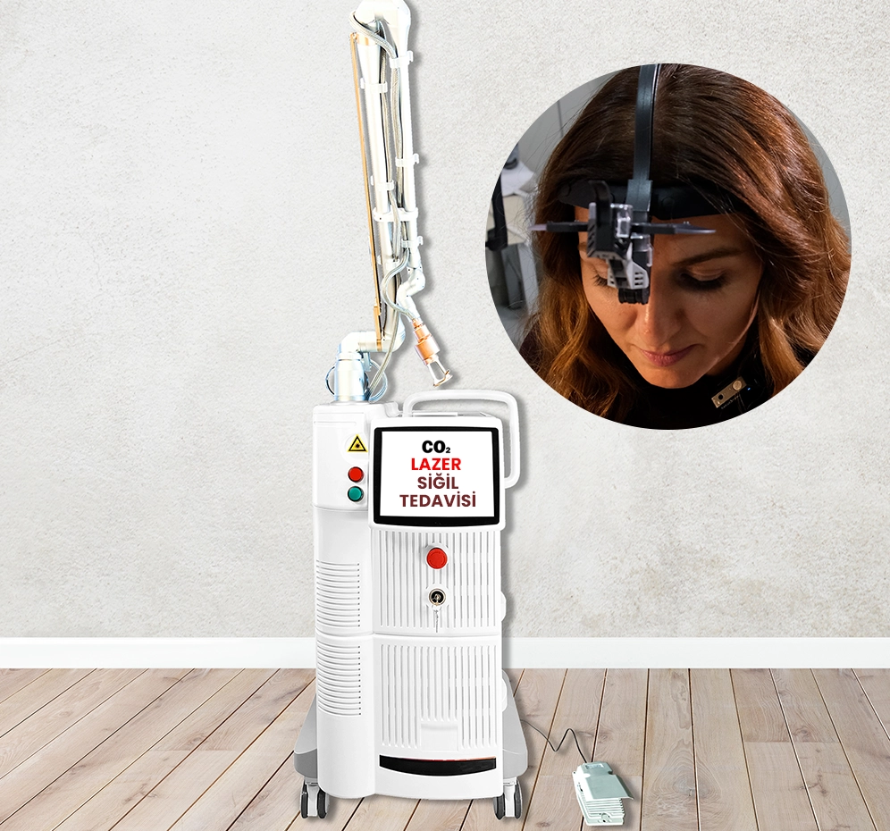 Lazer ile Siğil Tedavisi