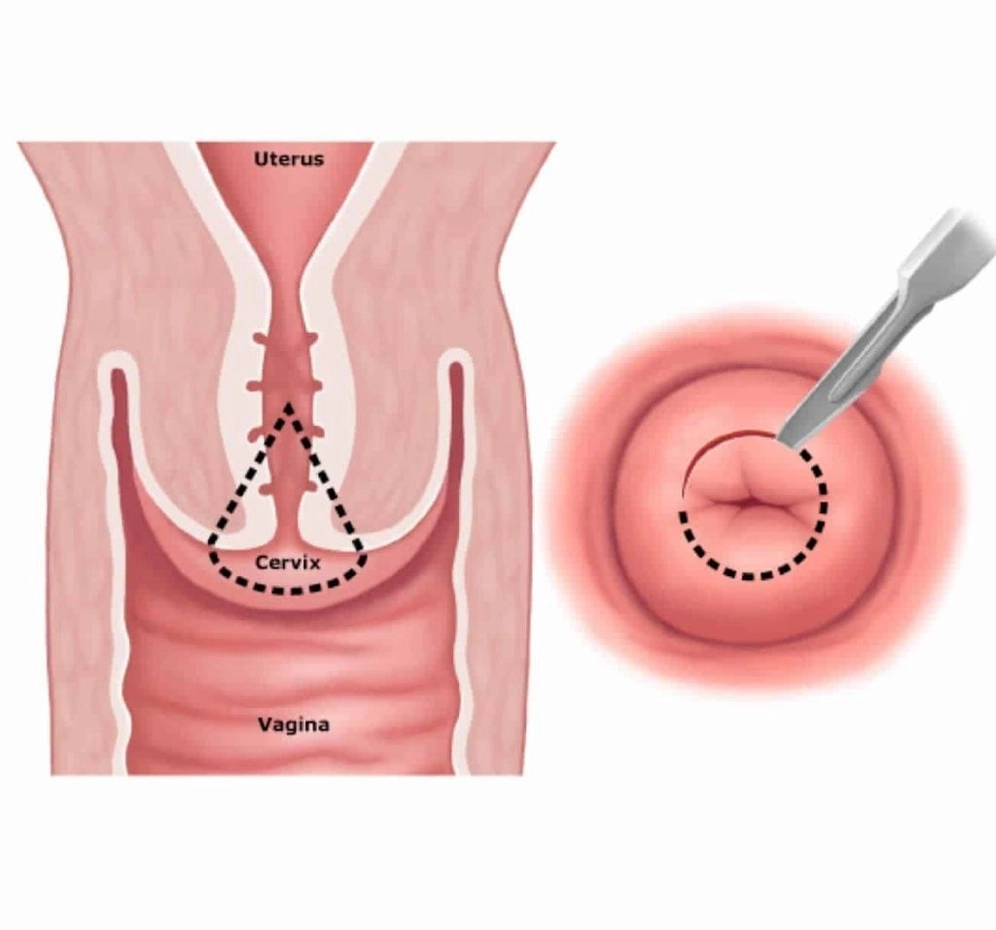 Radyofrekans ile Siğil Tedavisi