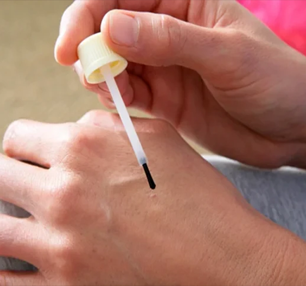 Siğil İlaçları | Topikal ve Medikal Tedaviler