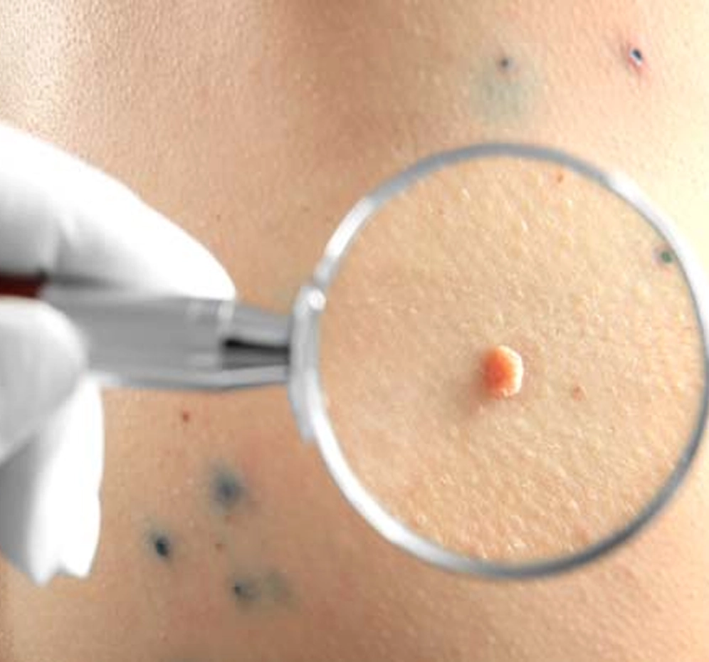 Siğil Tekrarlar mı?